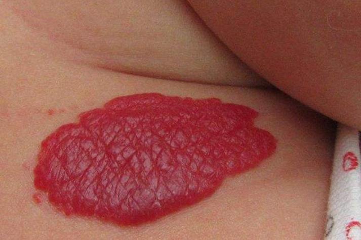 新生儿头后红色胎记是正常现象吗？需要担心健康问题吗？-第2张图片-郑州医学网