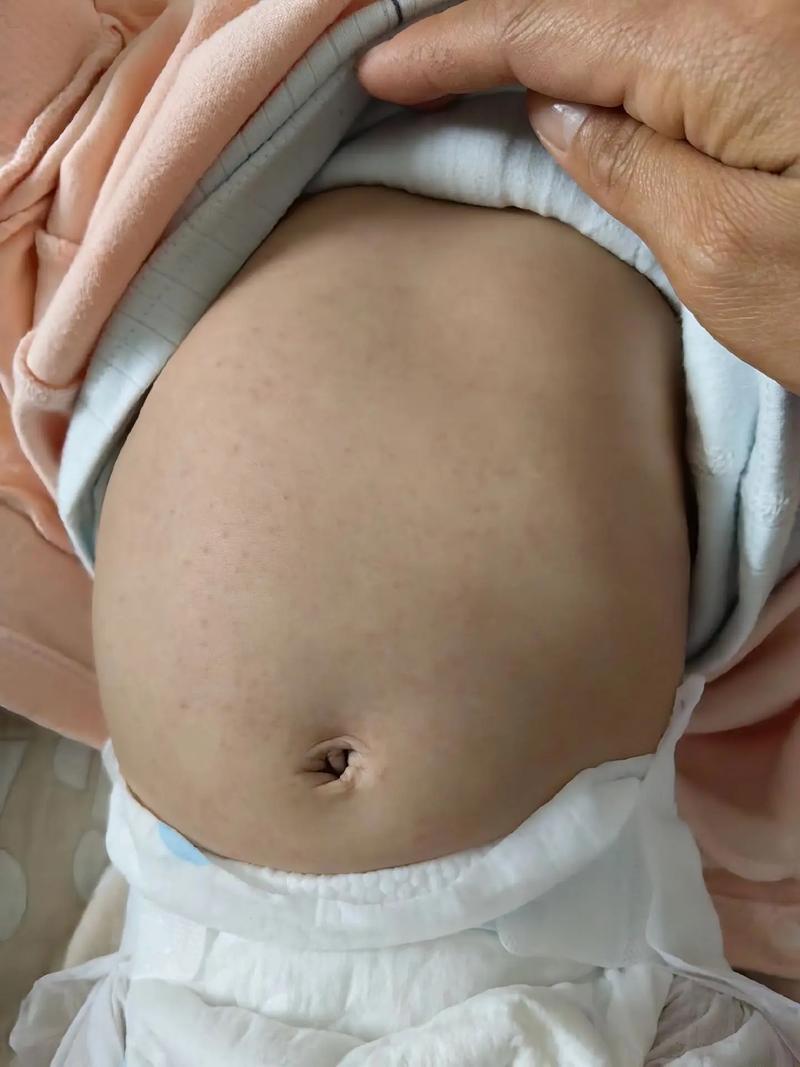 儿童急性淋巴细胞白血病哪种亚型更易复发？复发风险与哪些因素相关？-第1张图片-郑州医学网