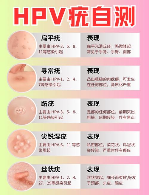 怀孕期间感染尖锐湿疣,会对胎儿造成哪些影响?-第2张图片-郑州医学网 怀孕期间感染尖锐湿疣,会对胎儿造成哪些影响?-第2张图片-郑州医学网