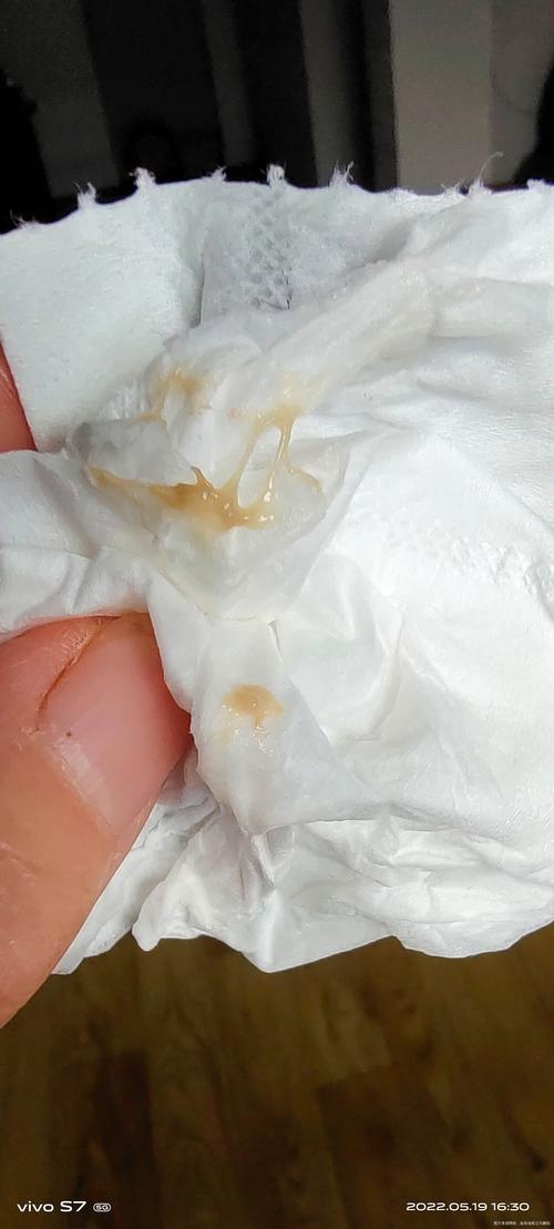 怀孕期间白带多有异味,是孕期正常现象还是妇科疾病的信号?-第1张图片-郑州医学网 怀孕期间白带多有异味,是孕期正常现象还是妇科疾病的信号?-第1张图片-郑州医学网