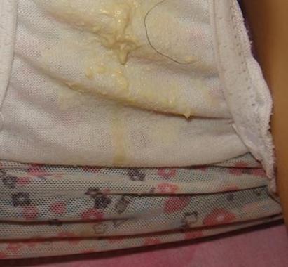 怀孕期间白带多有异味,是孕期正常现象还是妇科疾病的信号?-第3张图片-郑州医学网 怀孕期间白带多有异味,是孕期正常现象还是妇科疾病的信号?-第3张图片-郑州医学网