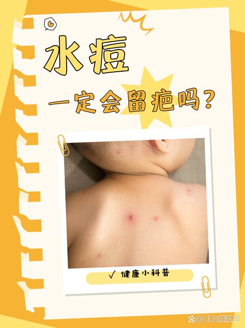 儿童得了水痘，家长该如何科学护理与用药治疗？-第2张图片-郑州医学网