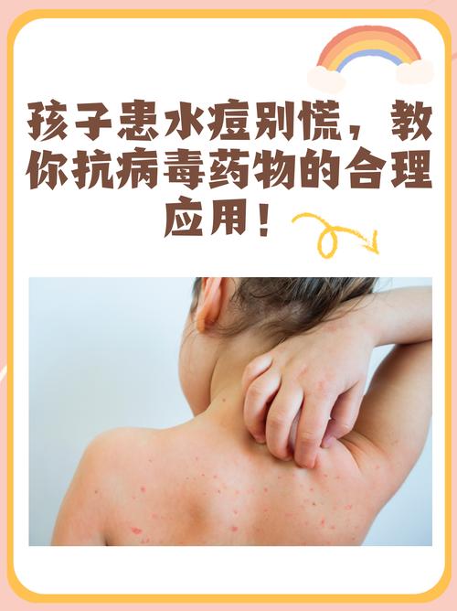 儿童得了水痘，家长该如何科学护理与用药治疗？-第3张图片-郑州医学网