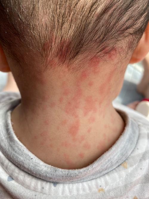 儿童出麻疹的症状图片有哪些典型表现及如何与其他皮疹区分？-第1张图片-郑州医学网
