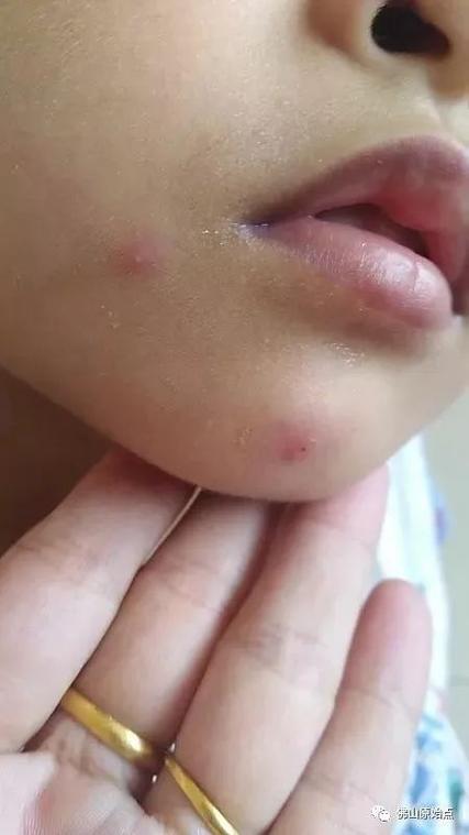 儿童出水痘的症状图片有哪些典型表现及如何辨别？-第2张图片-郑州医学网