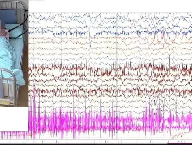 儿童大脑异常放电有哪些典型症状？家长该如何早期识别与干预？-第2张图片-郑州医学网