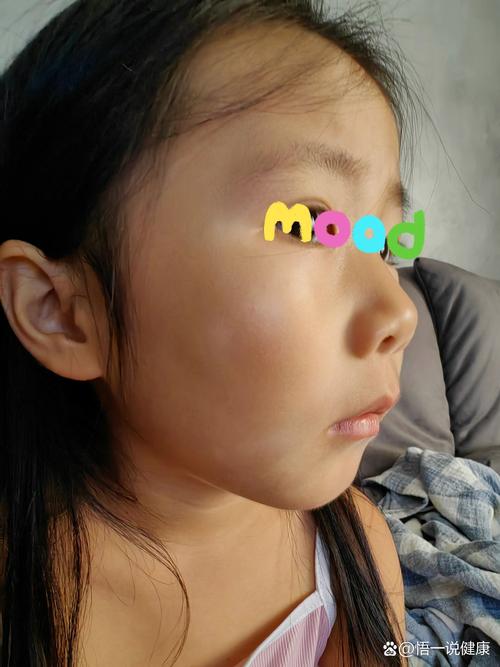 儿童皮肤白斑初期症状-第2张图片-郑州医学网