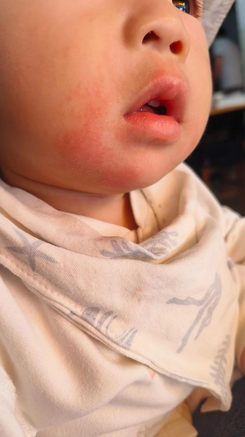 儿童嘴巴周围发红是上火了吗？该如何正确处理和预防？-第3张图片-郑州医学网