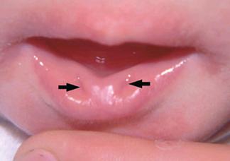 新生儿宝宝上嘴唇突出是正常发育还是异常信号？需警惕哪些潜在问题？-第3张图片-郑州医学网