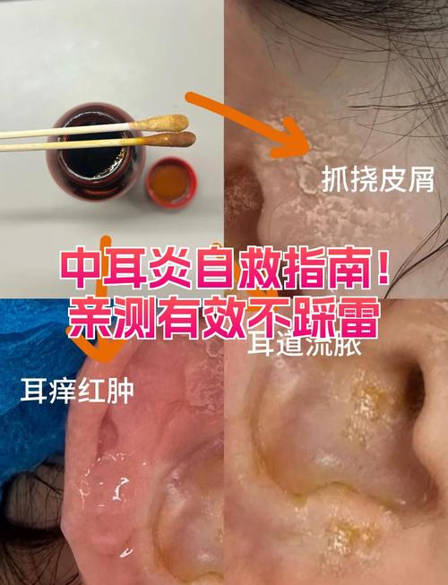 儿童中耳炎康复时间受哪些因素影响？多久能完全好？-第1张图片-郑州医学网