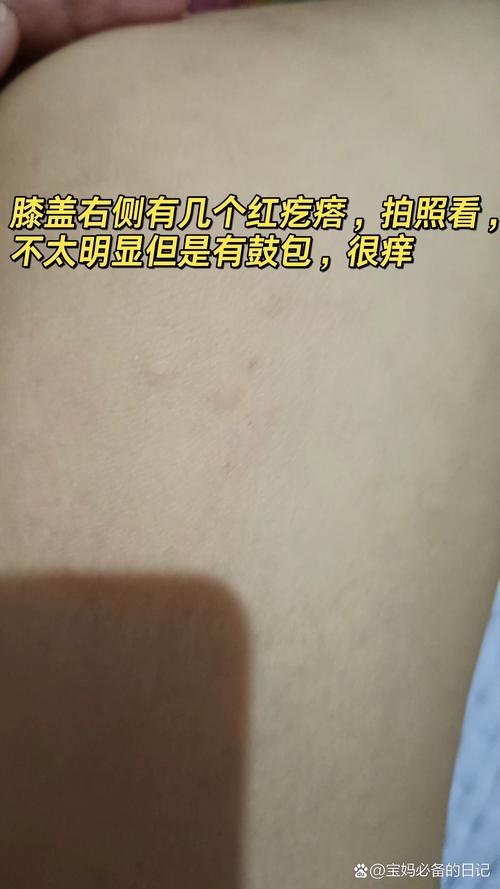 孕期身上起疙瘩却不痒，是正常现象还是身体异常信号？-第3张图片-郑州医学网