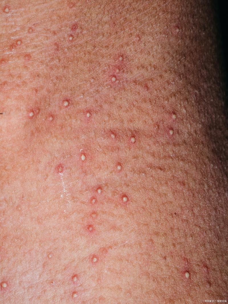 孕期身上起疙瘩却不痒，是正常现象还是身体异常信号？-第1张图片-郑州医学网