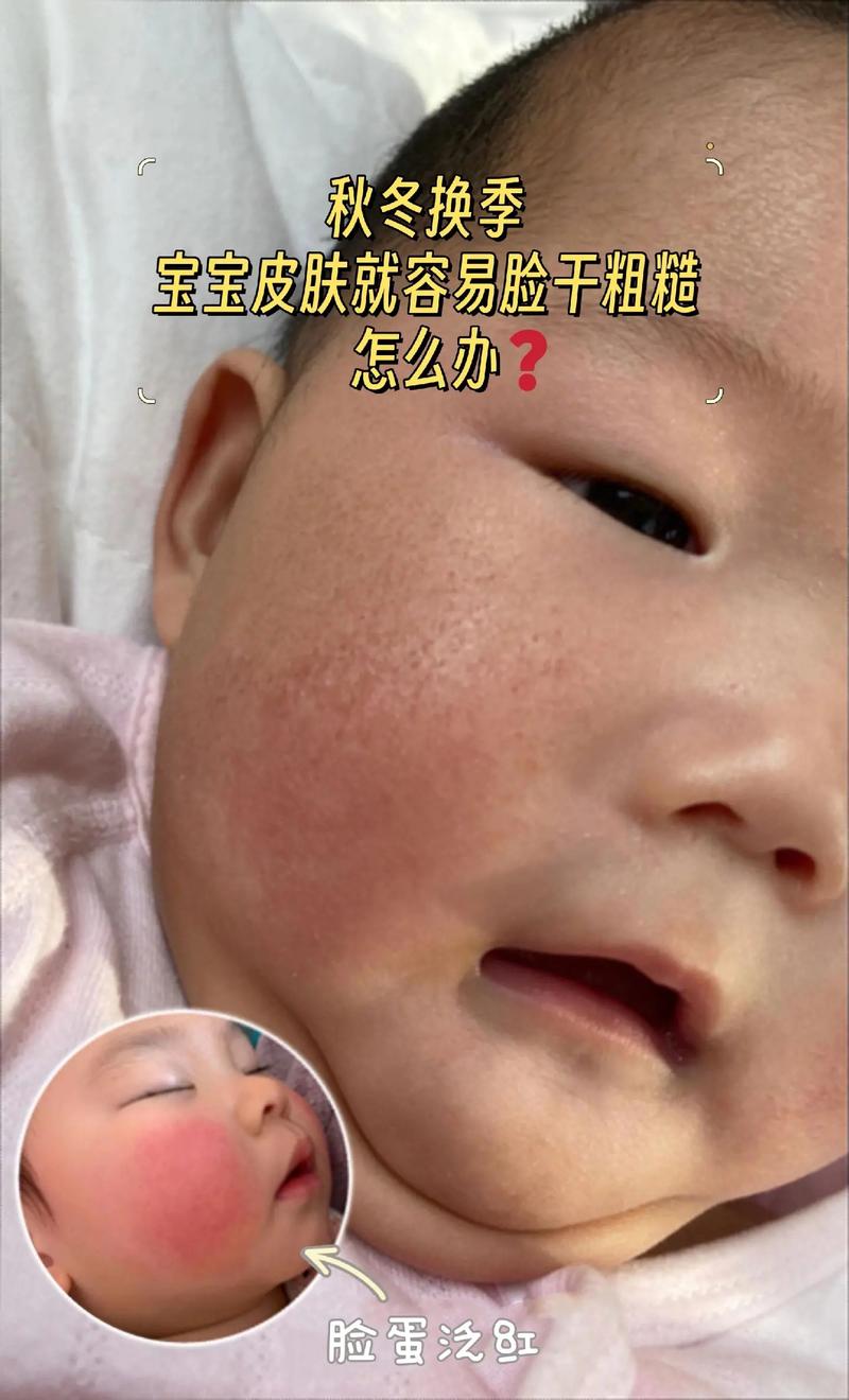 新生儿宝宝脸颊有点黄是正常现象还是健康预警？-第1张图片-郑州医学网