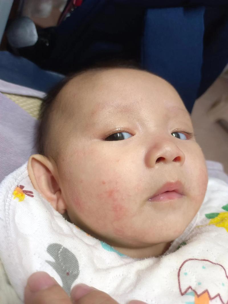 新生儿宝宝脸颊有点黄是正常现象还是健康预警？-第3张图片-郑州医学网