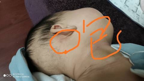 新生儿耳朵后出现红疙瘩是湿疹还是毛囊炎？需要怎么处理？-第1张图片-郑州医学网