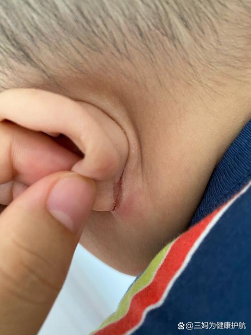 新生儿耳朵后出现红疙瘩是湿疹还是毛囊炎？需要怎么处理？-第2张图片-郑州医学网