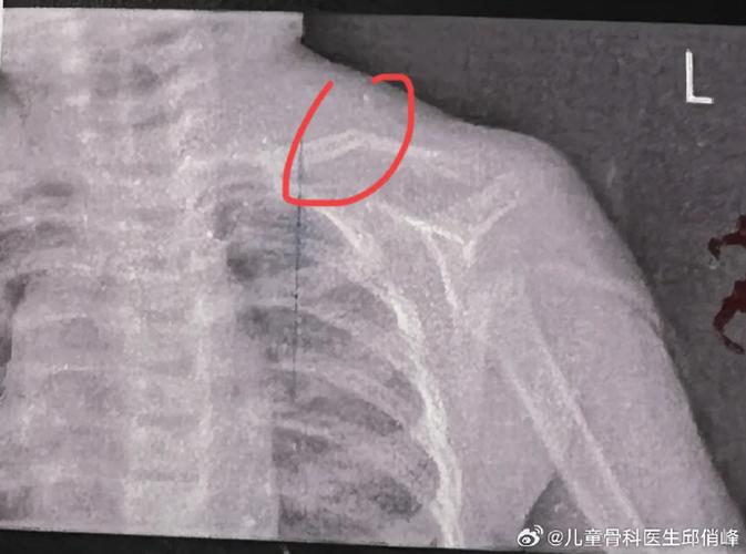 新生儿锁骨骨折后，正确的睡姿是怎样的？有哪些注意事项？-第2张图片-郑州医学网