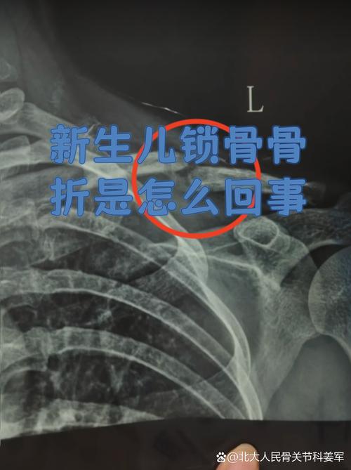 新生儿锁骨骨折后，正确的睡姿是怎样的？有哪些注意事项？-第3张图片-郑州医学网