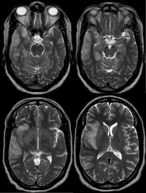儿童病毒性脑膜炎有哪些典型症状？家长该如何早期识别与应对？-第2张图片-郑州医学网