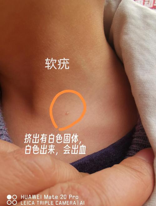 儿童软疣如何治疗才能彻底除根且避免复发？-第2张图片-郑州医学网