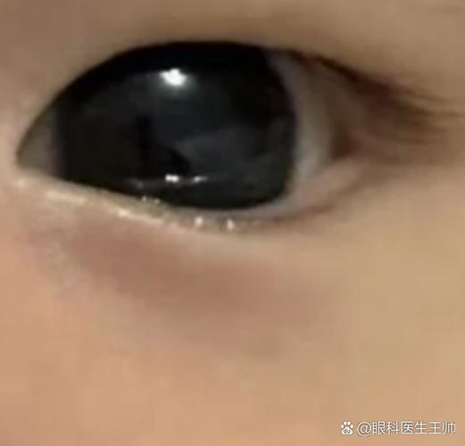 新生儿眼睛进毛纤维了怎么办？家长该如何正确处理和护理？-第1张图片-郑州医学网