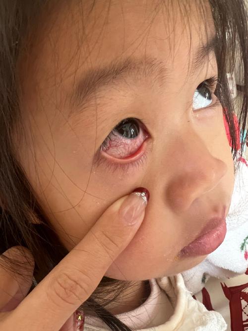新生儿眼睛进毛纤维了怎么办？家长该如何正确处理和护理？-第2张图片-郑州医学网