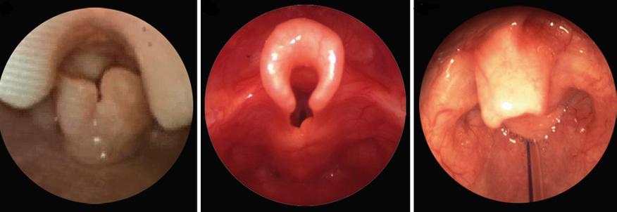 新生儿喉骨软化有哪些典型症状？家长如何辨别和应对？-第2张图片-郑州医学网