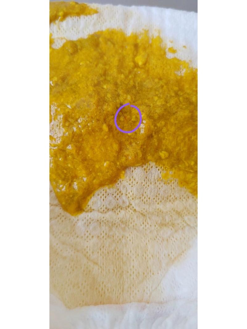 新生儿拉粑粑带血丝是上火还是肠道出问题了？-第2张图片-郑州医学网