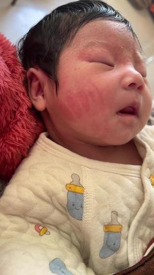 新生儿脸上长黄色结痂是湿疹还是痂皮？该怎么正确处理和护理？-第1张图片-郑州医学网