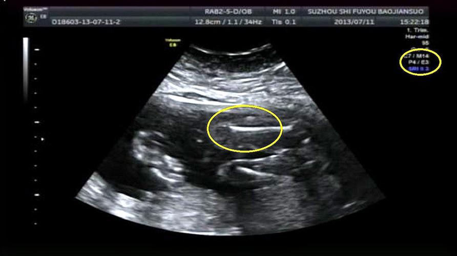 孕期梦见B超显示女孩，真的能预示胎儿性别吗？-第2张图片-郑州医学网