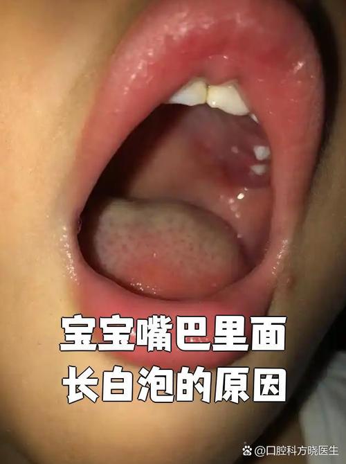 新生儿口腔有白色粘液是正常现象还是需要警惕的健康问题？-第2张图片-郑州医学网