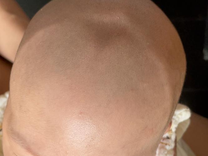 新生儿前后囟门位置有何不同？如何判断是否正常？-第3张图片-郑州医学网