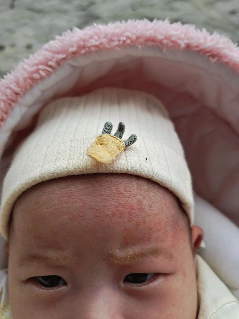 新生儿为何也会长痤疮？是激素影响还是护理不当？-第1张图片-郑州医学网