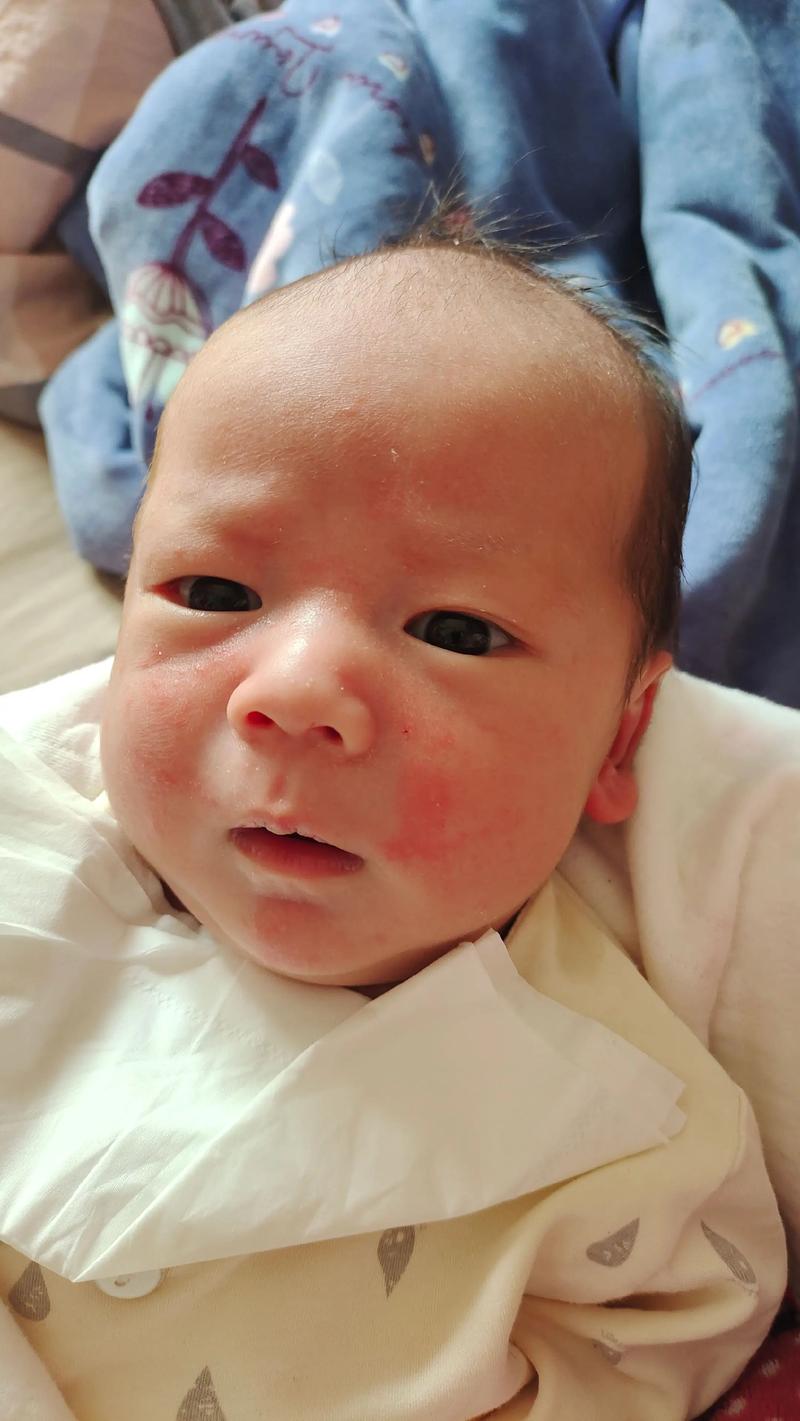 新生儿为何也会长痤疮？是激素影响还是护理不当？-第2张图片-郑州医学网