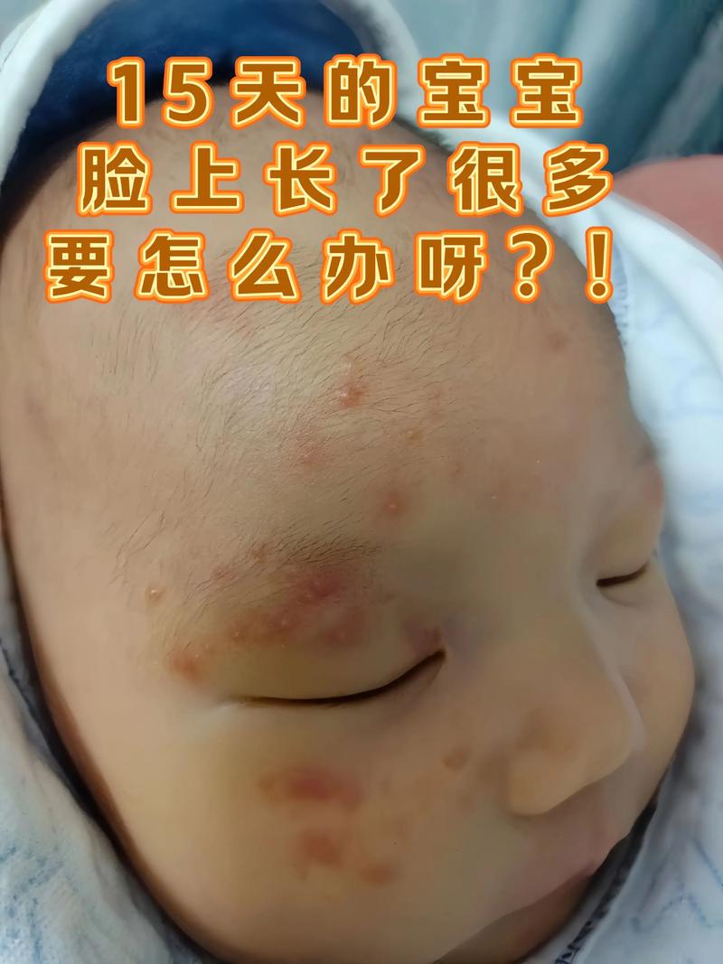 新生儿为何也会长痤疮？是激素影响还是护理不当？-第3张图片-郑州医学网