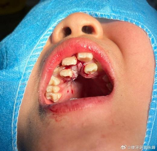 儿童上门牙多生牙图片，多生牙会挤歪正常牙吗？需要拔除吗？-第1张图片-郑州医学网