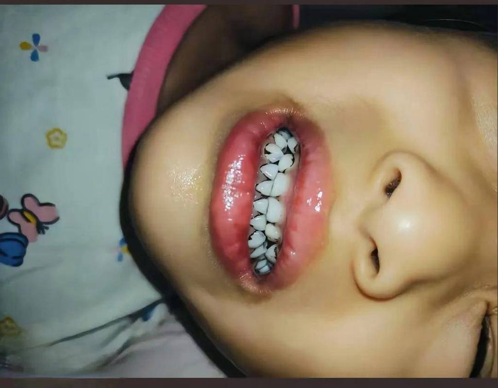 儿童铅中毒症状隐匿，后果有多严重？家长该如何早期识别与干预？-第2张图片-郑州医学网