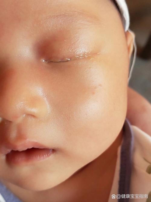 新生儿泪腺管不通症状-第2张图片-郑州医学网