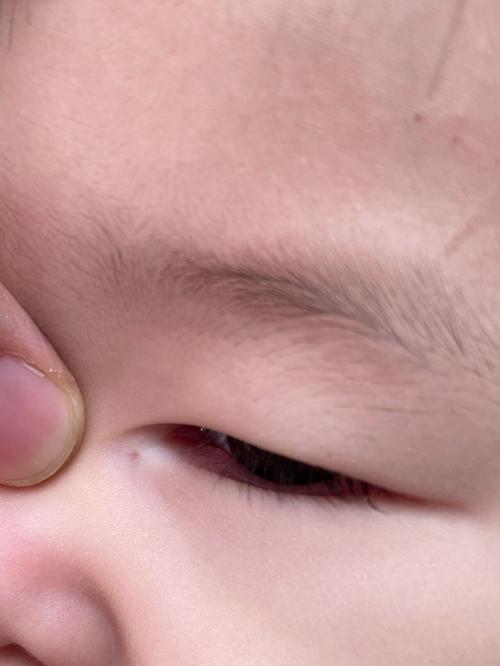 新生儿泪腺管不通症状-第3张图片-郑州医学网