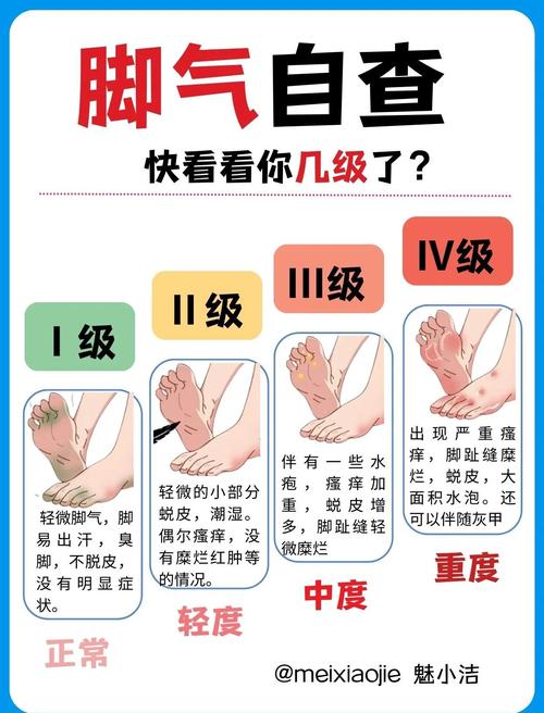 儿童得了脚气怎么办？日常护理和用药有哪些注意事项？-第2张图片-郑州医学网