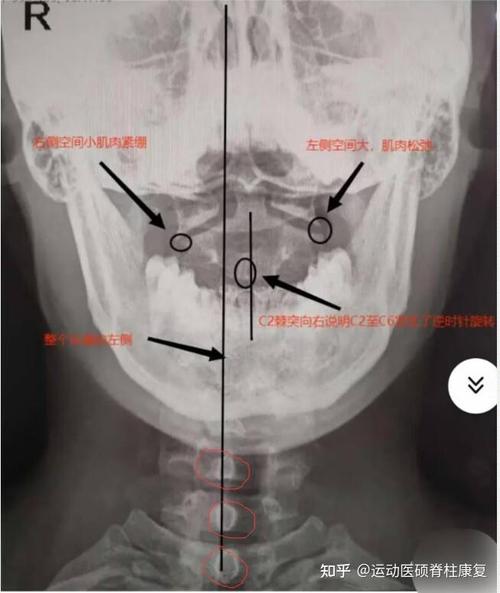 儿童寰枢椎半脱位究竟有哪些潜在诱因？外伤、发育异常还是其他因素在作祟？-第3张图片-郑州医学网