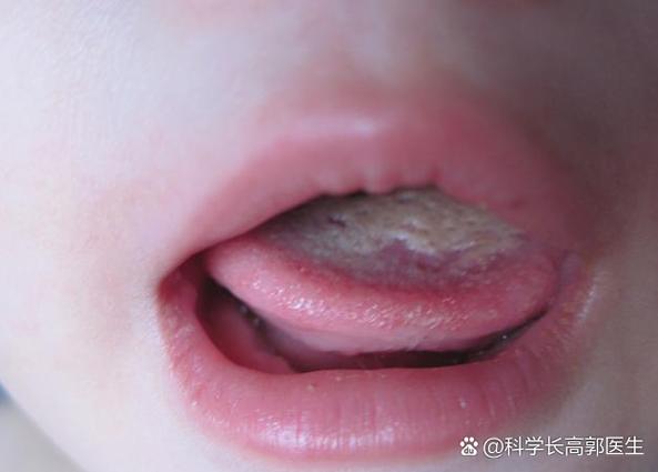 新生儿急性胃黏膜出血的诱因、诊疗要点及预后如何？-第3张图片-郑州医学网