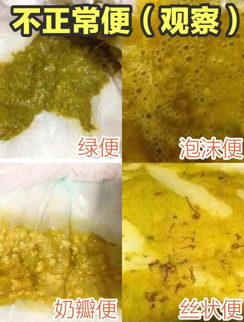 新生儿出生后排便但无小便，是正常生理现象还是异常信号？-第1张图片-郑州医学网