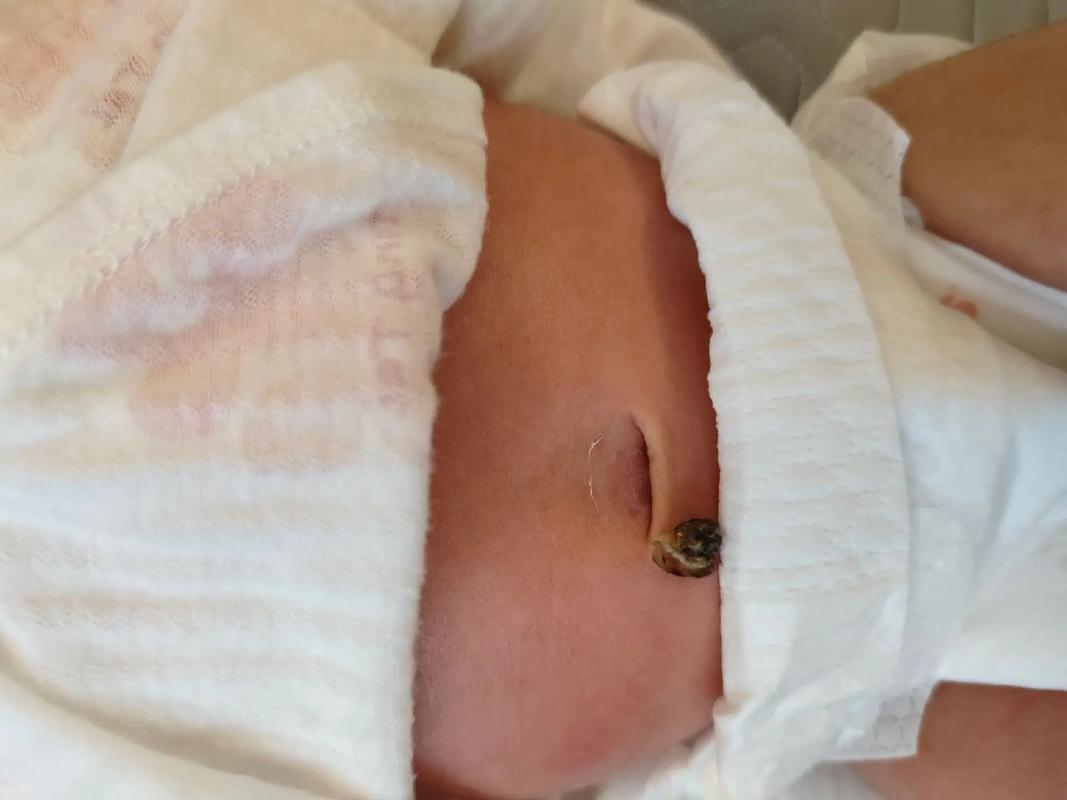 新生儿脐带脱落后鼓起是正常现象吗？需要担心感染或脐疝吗？-第1张图片-郑州医学网