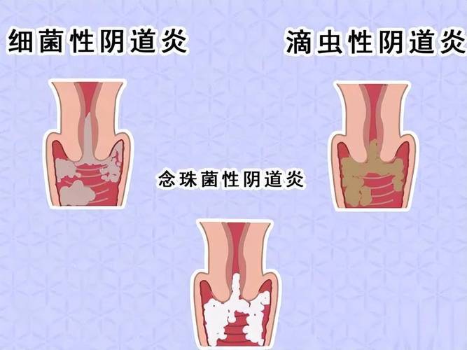 孕期外阴肿胀正常吗？需警惕哪些潜在风险？-第2张图片-郑州医学网