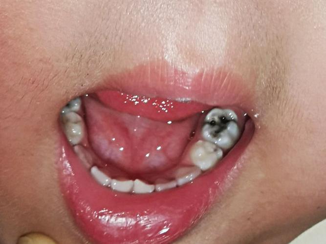 3岁儿童牙齿发黑烂掉，是蛀牙还是其他问题？家长该如何应对？-第2张图片-郑州医学网