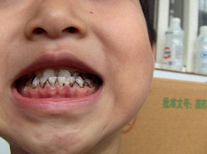 3岁儿童牙齿发黑烂掉，是蛀牙还是其他问题？家长该如何应对？-第1张图片-郑州医学网