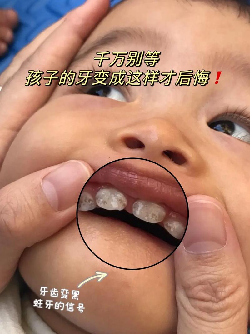 3岁儿童牙齿发黑烂掉，是蛀牙还是其他问题？家长该如何应对？-第3张图片-郑州医学网