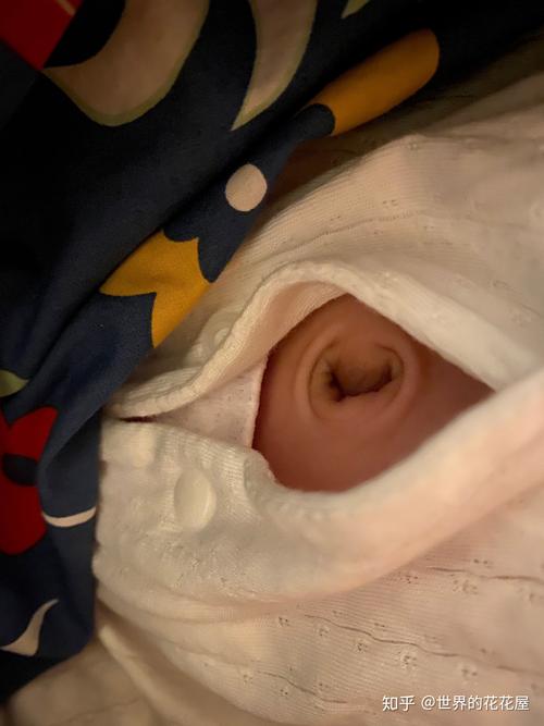 新生儿肚脐突出用硬币矫正靠谱吗？这样处理会不会有感染风险？-第1张图片-郑州医学网