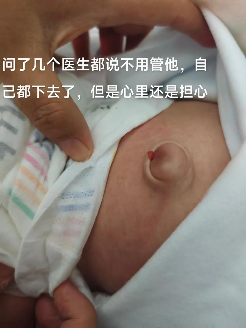 新生儿肚脐突出用硬币矫正靠谱吗？这样处理会不会有感染风险？-第3张图片-郑州医学网